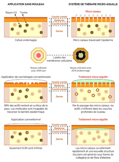 Mésothérapie InnoPen avant traitement pour la repousse des cheveux / InnoPen Mesotherapy before treatment for hair growth.