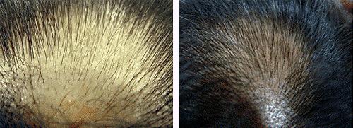 Mésothérapie InnoPen avant traitement pour la repousse des cheveux / InnoPen Mesotherapy before treatment for hair growth.