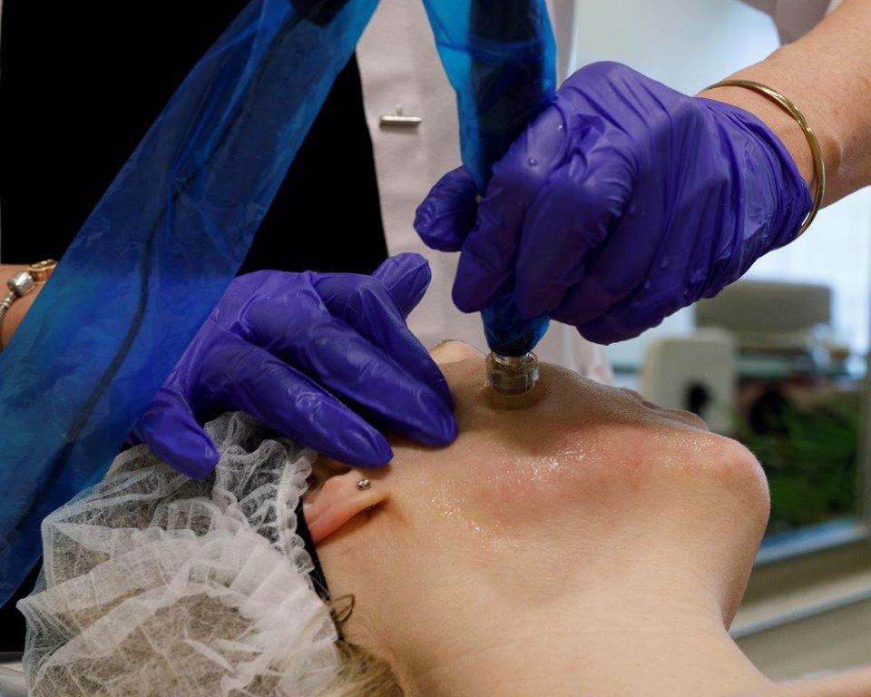 Avant et après micro-aiguille / Before and after micro-needling