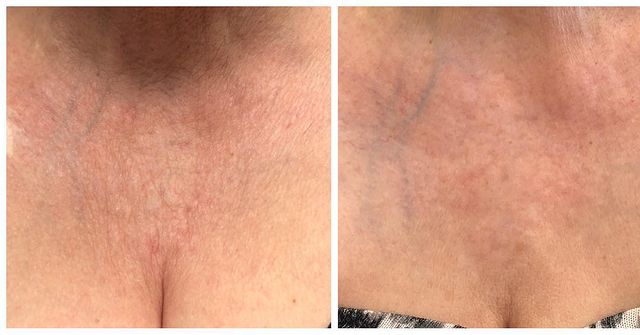 Mésothérapie InnoPen pour la poitrine / InnoPen Mesotherapy for chest.